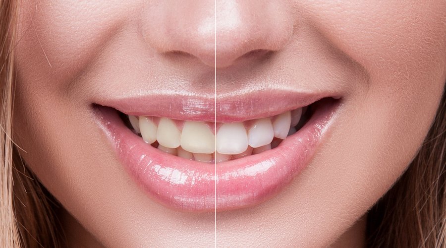Sonrisa mostrando antes y después de blanqueamiento dental — cursos online